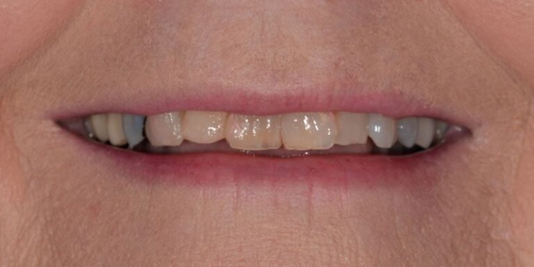 smile-gallery-3-before-pearl-dentistry