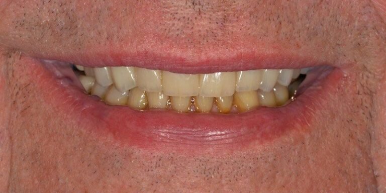 smile-gallery-4-after-pearl-dentistry